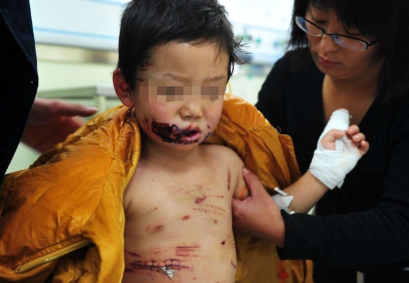 3岁男童遭猛犬撕咬遍体鳞伤